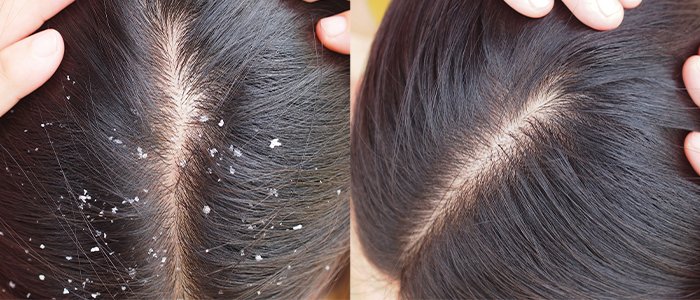 Anti Dandruff Treatment in Kakinada