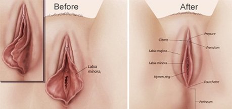 Labiaplasty Surgery in Kakinada