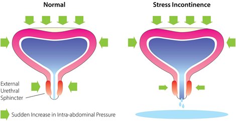 Vaginal Laser Therapy in Kakinada