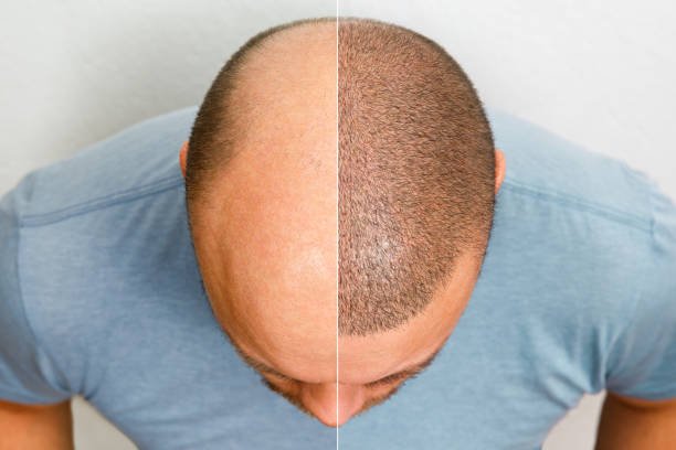 Going Bald After Hair Transplant