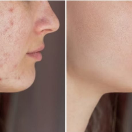 Acne Scar Removal-post1