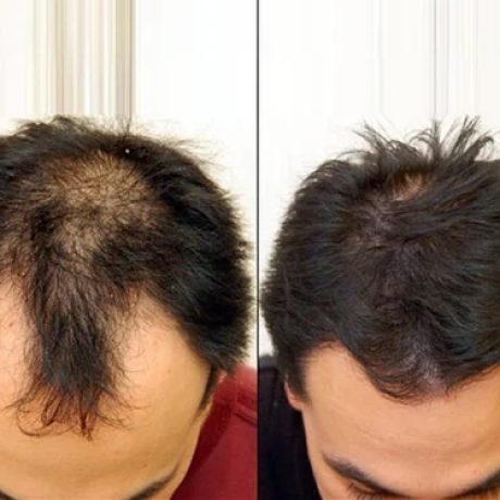 hair transplantation in kakinada